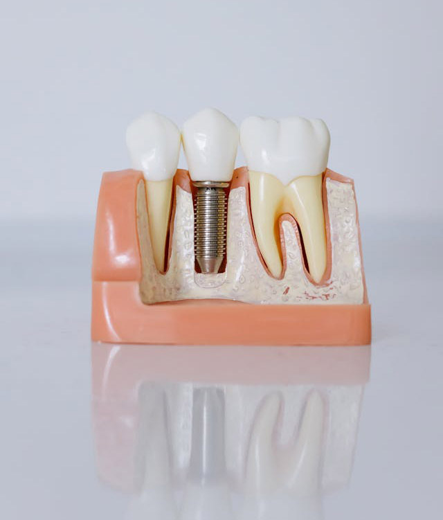 Close-up shot of a dental implant mode