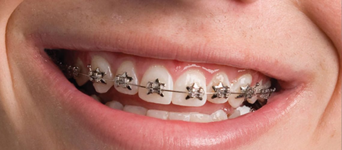 https://www.definitivedental.com/wp-content/uploads/elementor/thumbs/Phases-of-Orthodontic-Treatment-olcko64a5e6087ab5n4cmg833ndp6e1iftc1qwa6q0.jpg