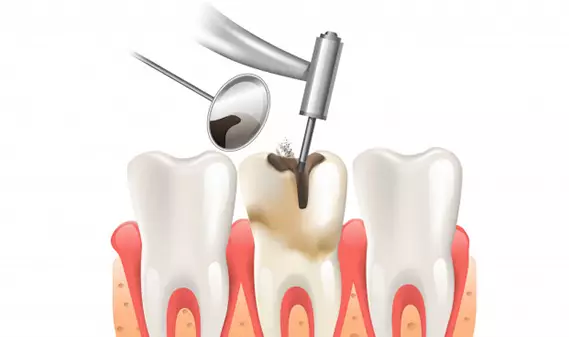 Who Is A Candidate For A Root Canal